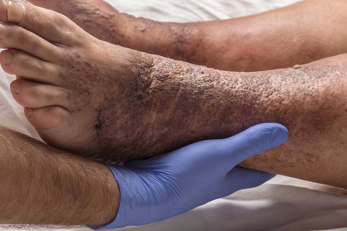 varicose veins