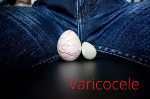 How to get rid of varicocele naturally