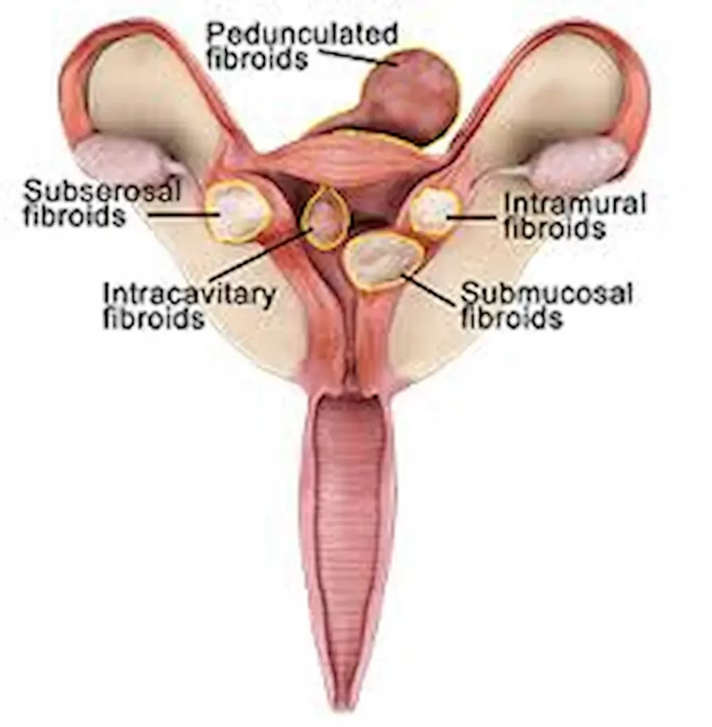 Fibroid Surgery Recovery