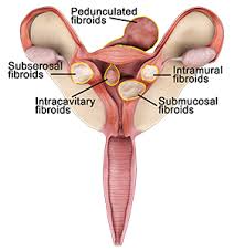 Fibroid Treatment