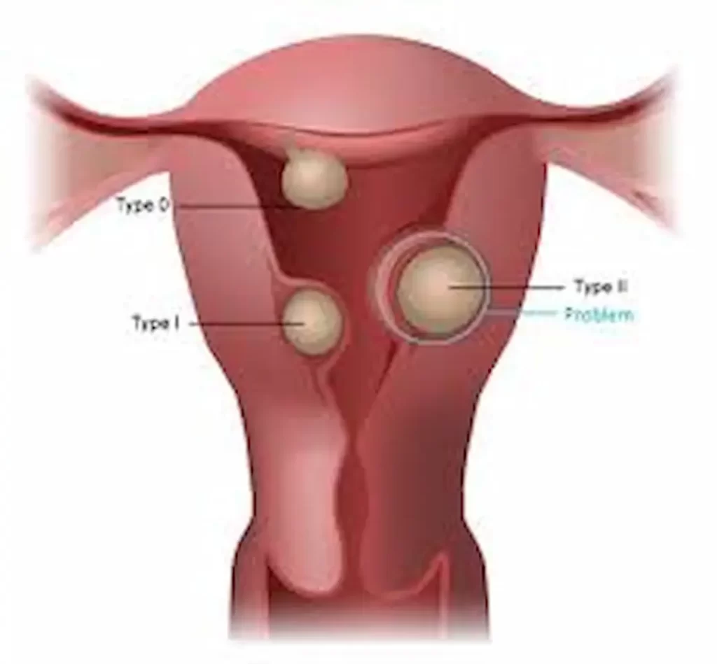 Fibroid Surgery Recovery