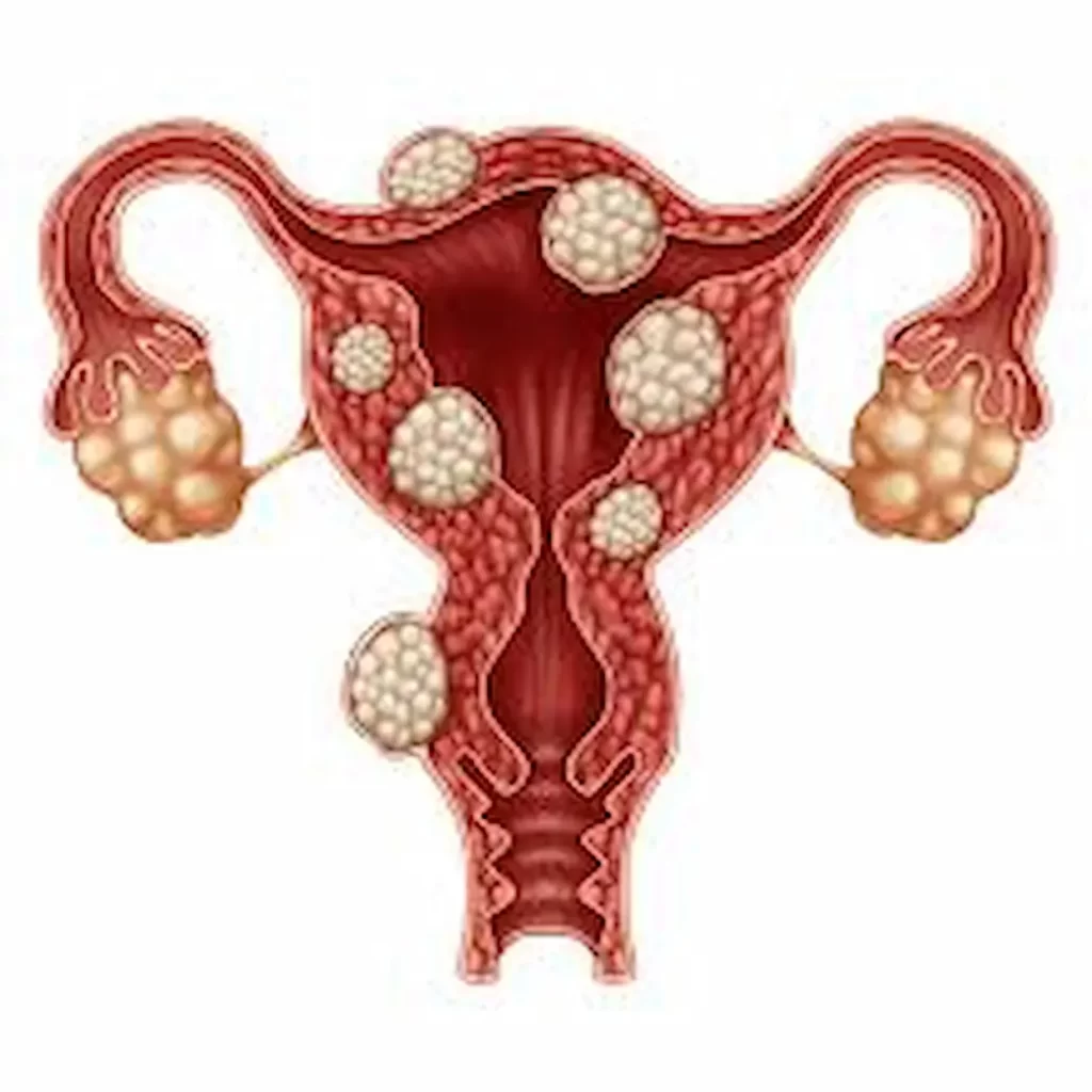 fibroid treatment