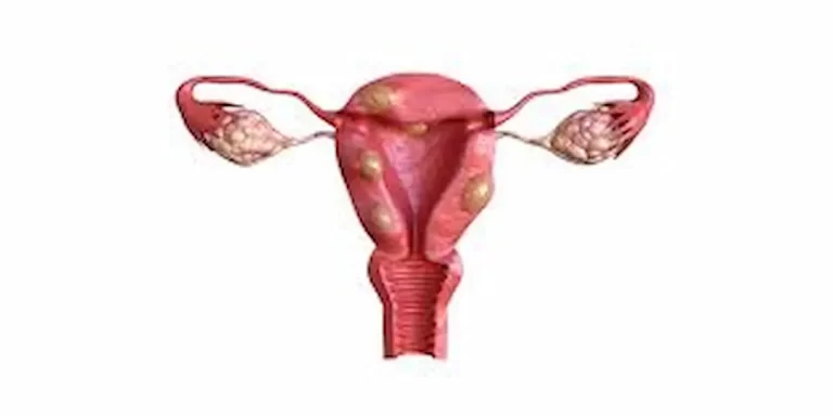 Fibroid Treatment: Comprehensive Guide To Managing Fibroids 2024