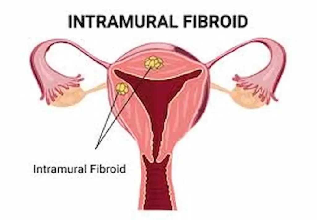 Fibroid Surgery Recovery