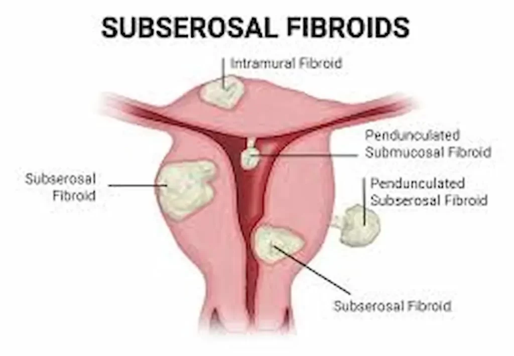 Fibroid Surgery Recovery