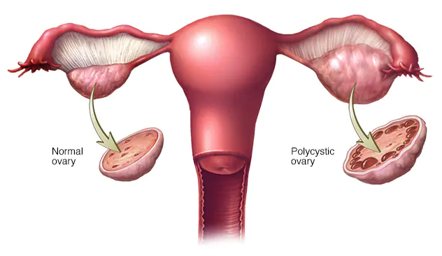 pcos